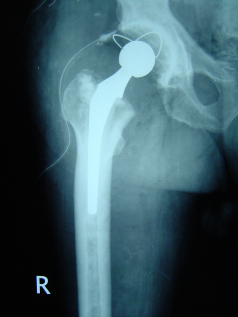 Post Operative X-Ray Cemented Hip Replacement